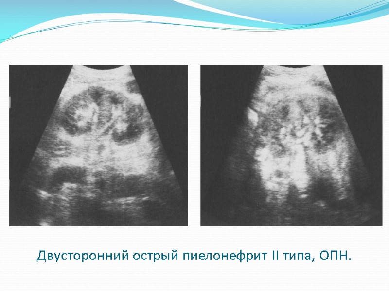 Двусторонний острый пиелонефрит II типа, ОПН.